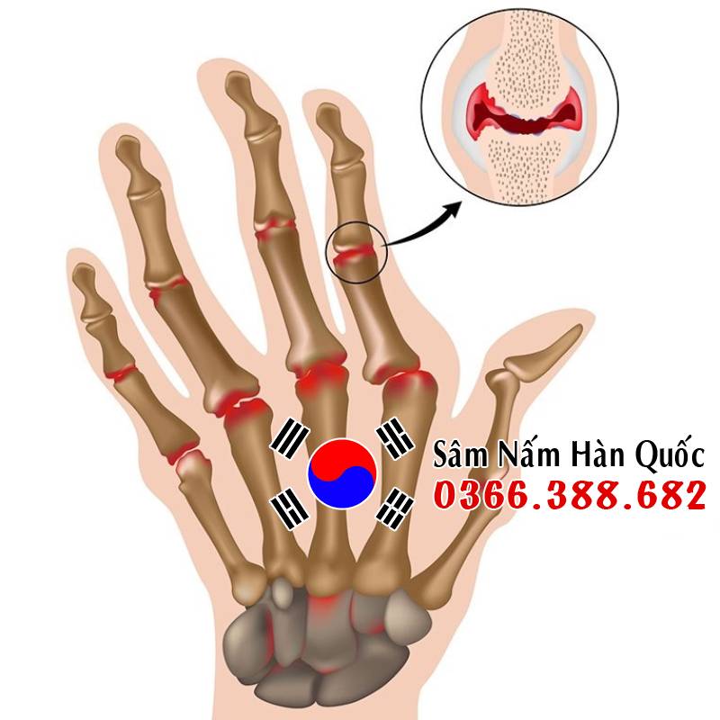 Người bị Gout có uống Sâm được không? Bệnh gout là dạng viêm khớp do sự tích tụ tinh thể axit uric trong cơ thể