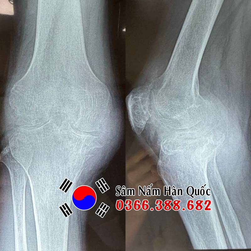 Người bị Gout có uống Sâm được không? Lưu ý khi dùng nhân sâm cho người bị gout